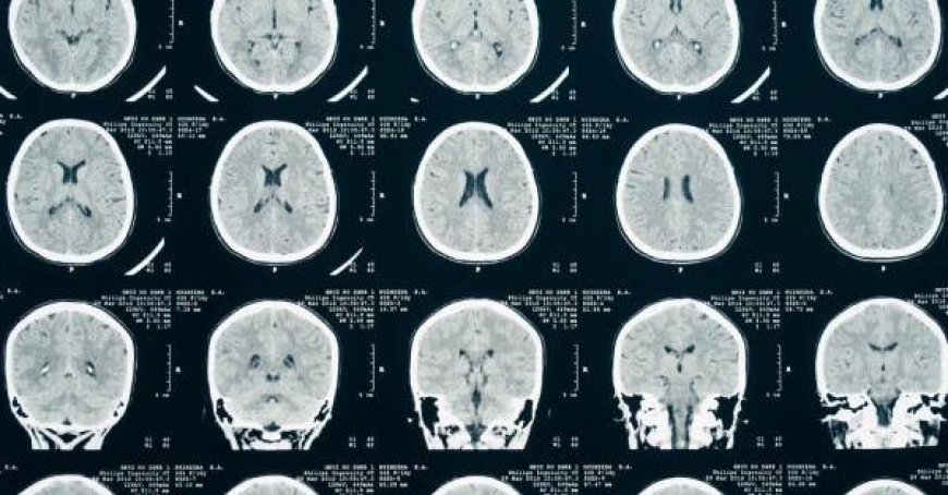Un test sanguin vital dans l’heure suivant un traumatisme cérébral